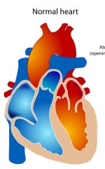 Diagram showing a healthy heart and one suffering from hypoplastic left heart syndrome